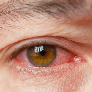 Image of eye irritation from 1,4 dioxane